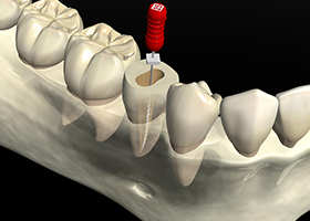 根管治療 イメージ画像