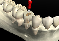 根管治療 イメージ画像