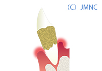 歯周病の改善 イメージ画像