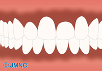 歯肉のメラニン色素沈着を改善 イメージ画像