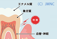 知覚過敏 イメージ画像