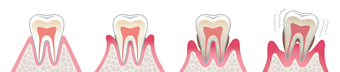 歯周病とは イメージ画像